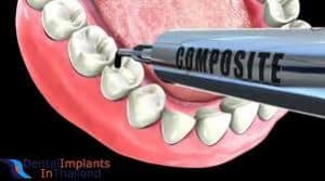 composite dental